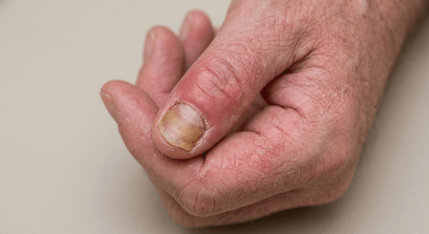 Close-up of contact dermatitis around fingernails showing inflamed red skin and swollen nail folds